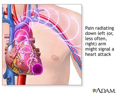 heart attack symptoms in women. between a Heart Attack and